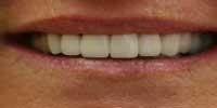 Crown and Bridge After