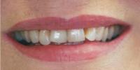 Veneers & Crowns Before