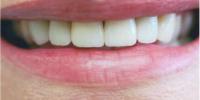 Veneers & Crowns After
