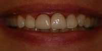 Crown and Bridge After