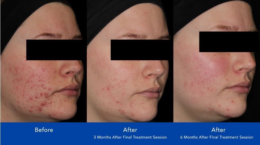 3 - 6 Months Treatment Before and After Images