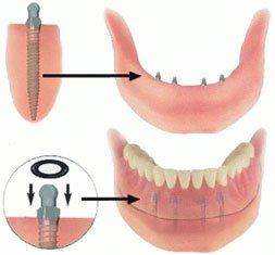 Dental+Associates+Of+Dublin_implants