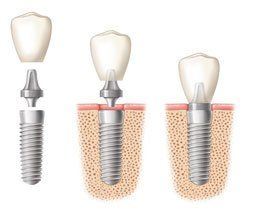 Dental+Associates+Of+Dublin_implants