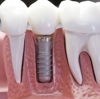 Dental implant model showing a metal implant post between white teeth and pink gums