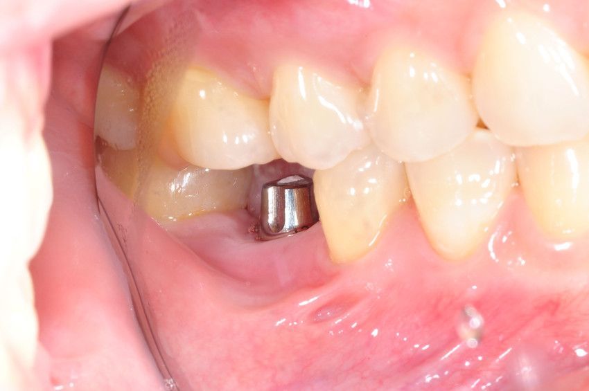 A close up of a person 's mouth with a dental implant preperation.