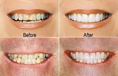 Before and after photos - teeth whitening