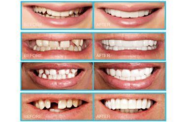 Before and after photos - missing and misaligned teeth