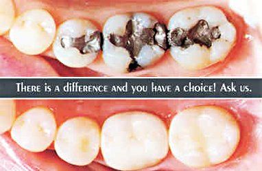 Before and after photos - natural color fillings