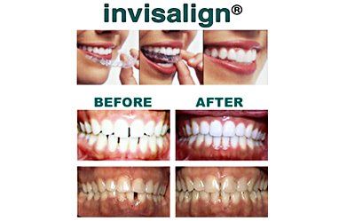Before and after photos - Invisalign