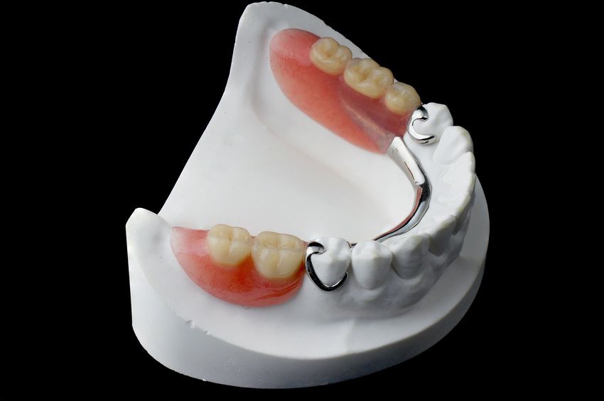 A model of a denture with a metal bracket.