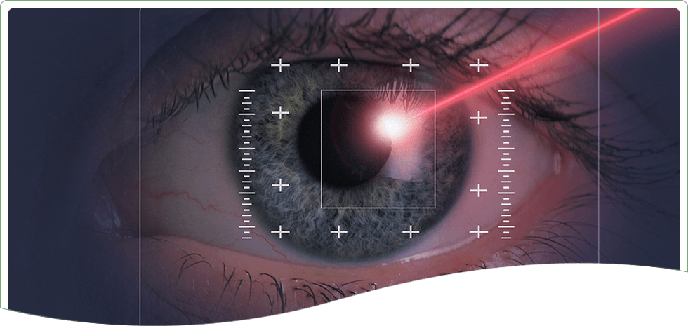 Laser vision correction