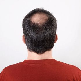 balding man's head