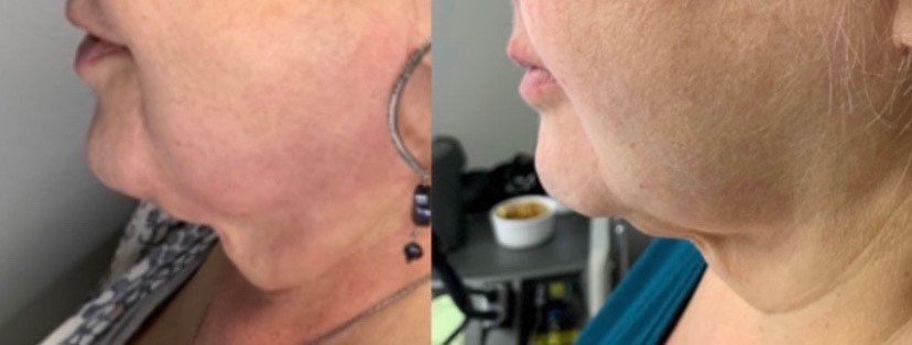 Venus Freezes Plus Treatment