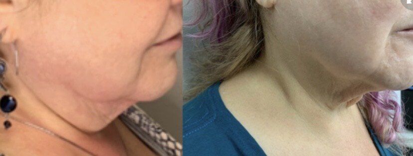 Venus Freezes Plus Treatment