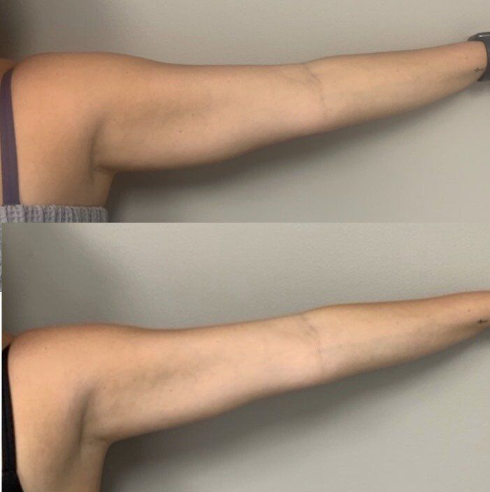 Venus Freezes Plus Treatment