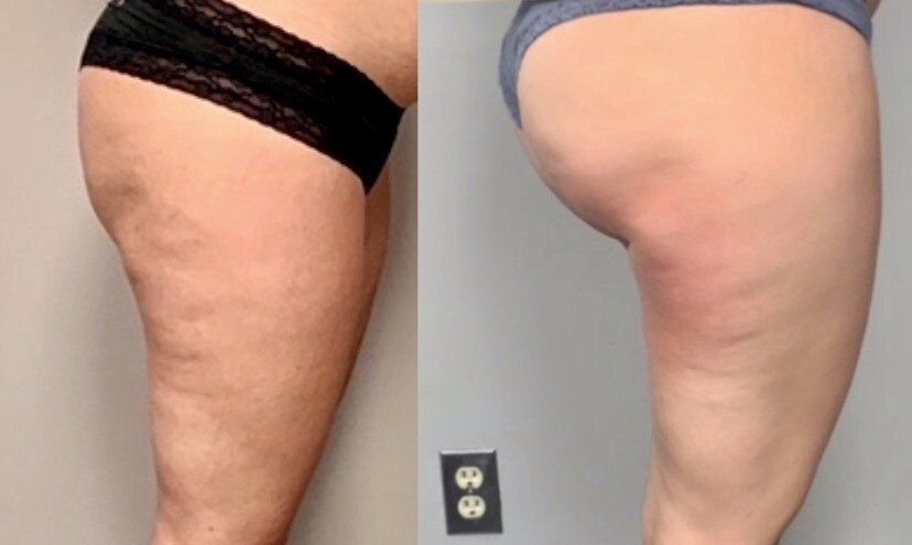 Venus Freezes Plus Treatment