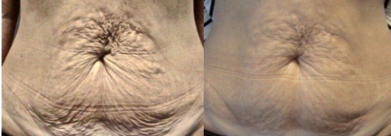Venus Freezes Plus Treatment