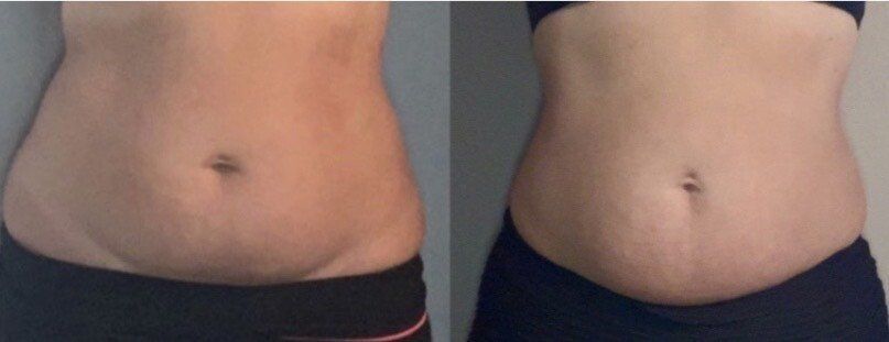 A before and after picture of a woman 's stomach.