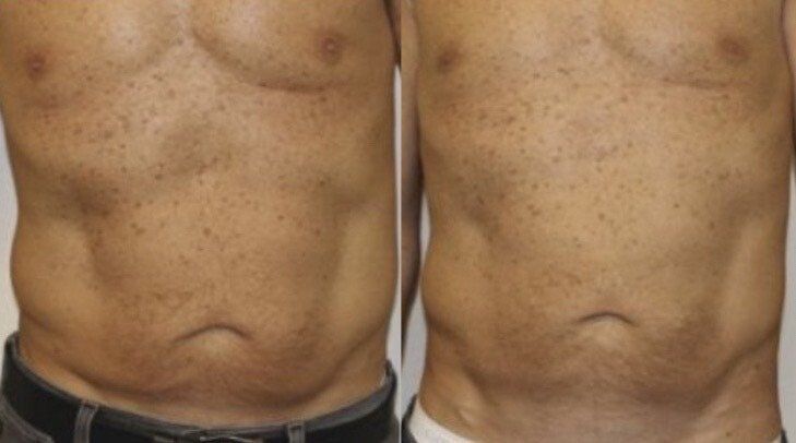 A before and after picture of a man 's stomach