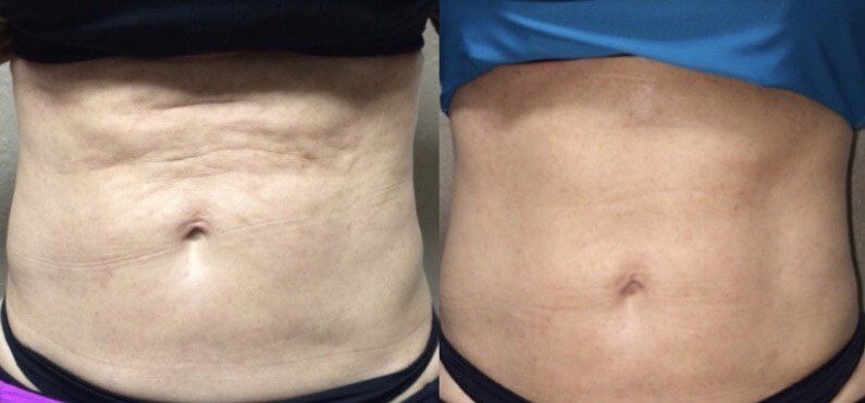 A before and after picture of a woman 's stomach.