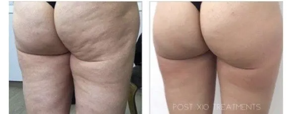 before and after photo of cellulite