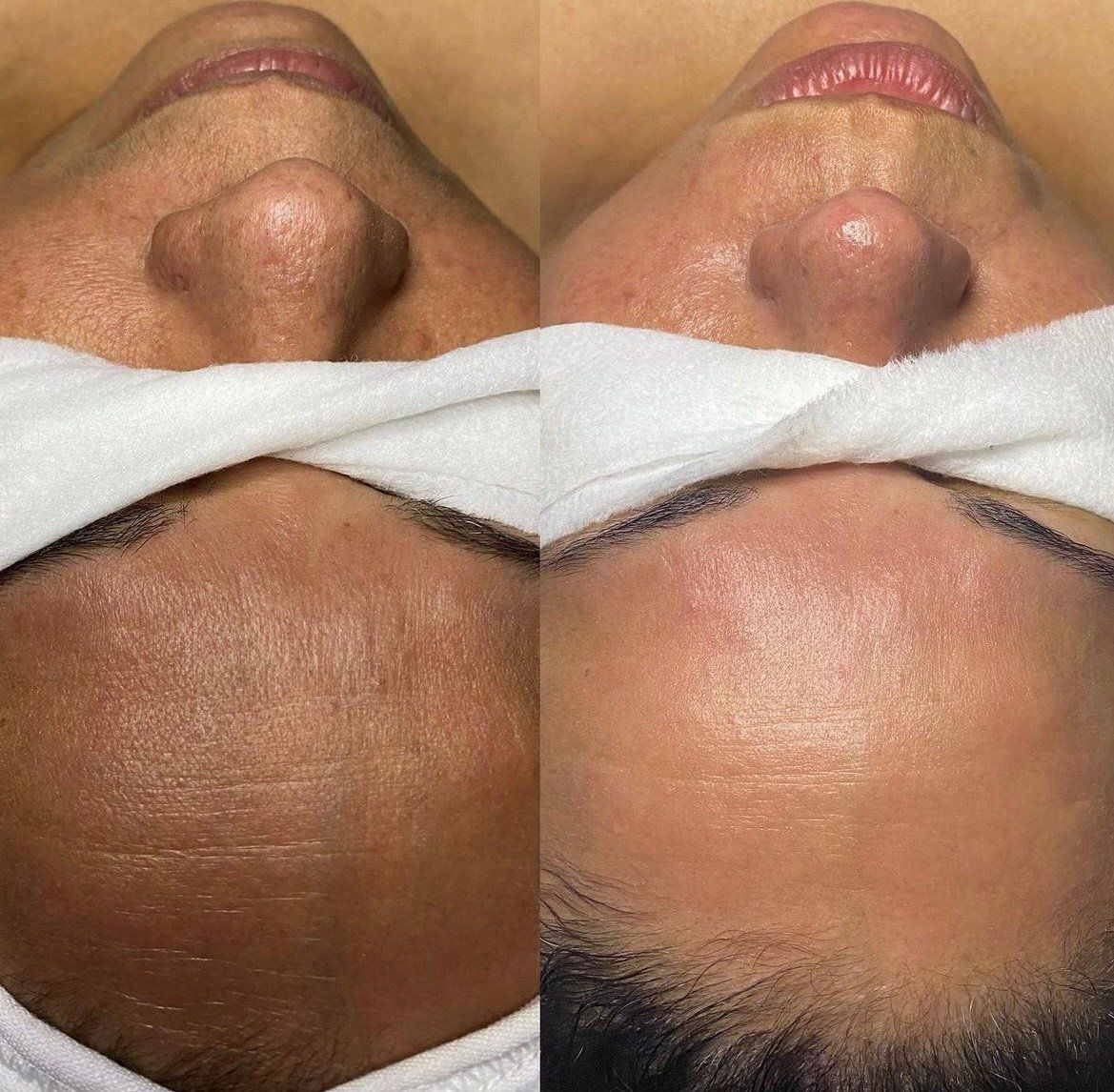 Chitossil™ non-invasive facial - Before and After