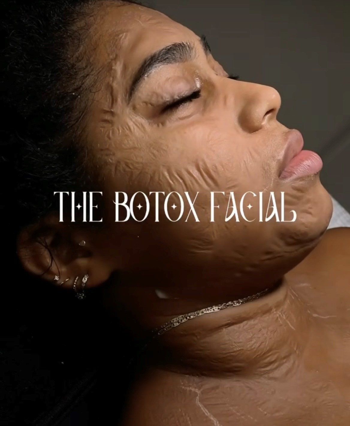The Botox facial