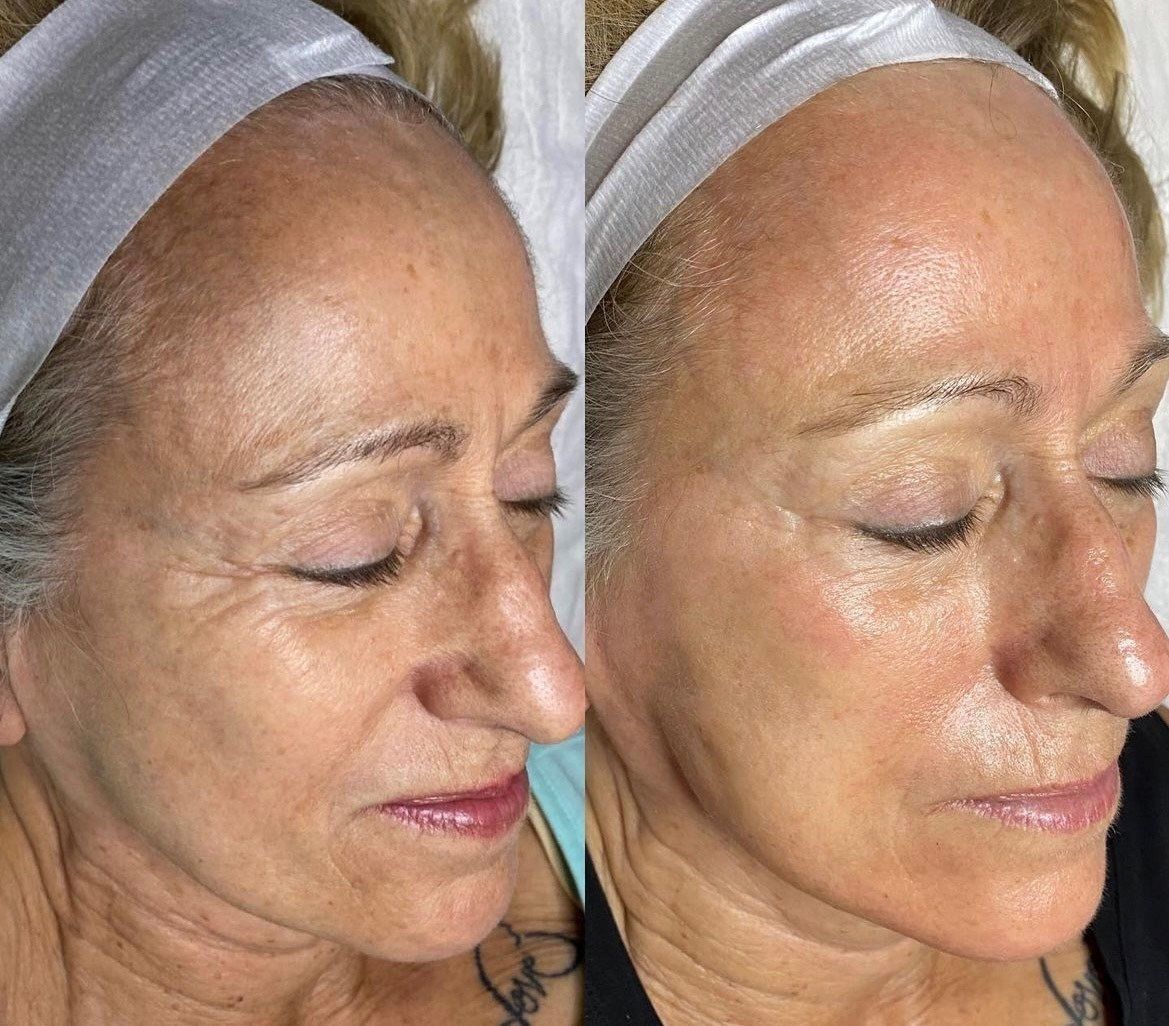 Botox Facial - Before and After