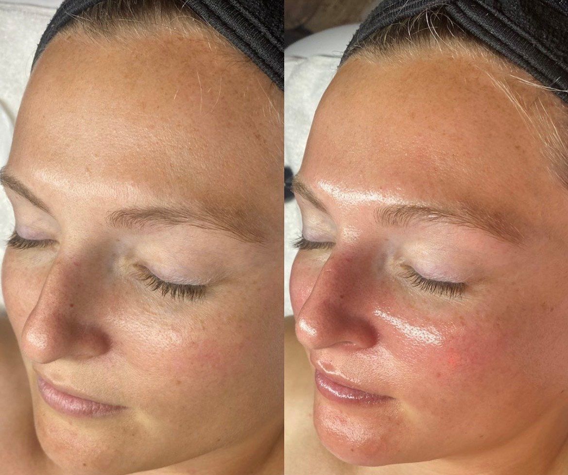 TOX Facial - Before and After