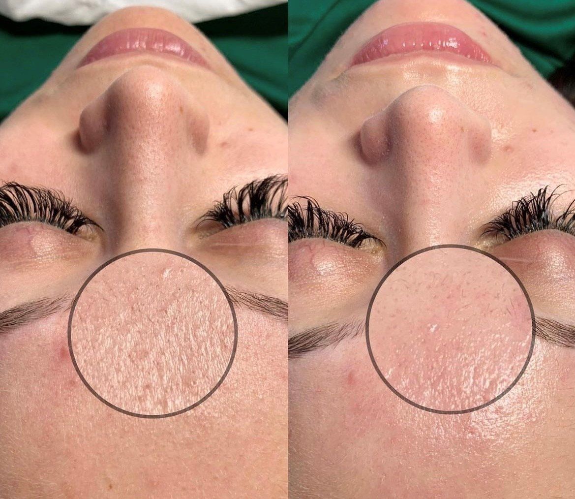TOX Facial zoomed in skin on forehead - Before and After