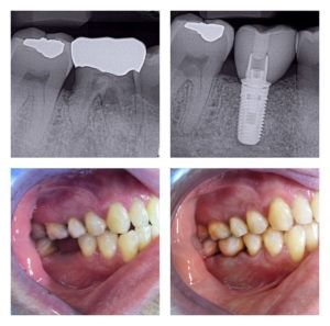 mplant-and-restorative-dentistry