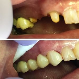 mplant-and-restorative-dentistry-bridges