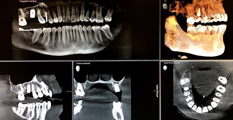 mplant-and-restorative-dentistry-dental-implant-benifits