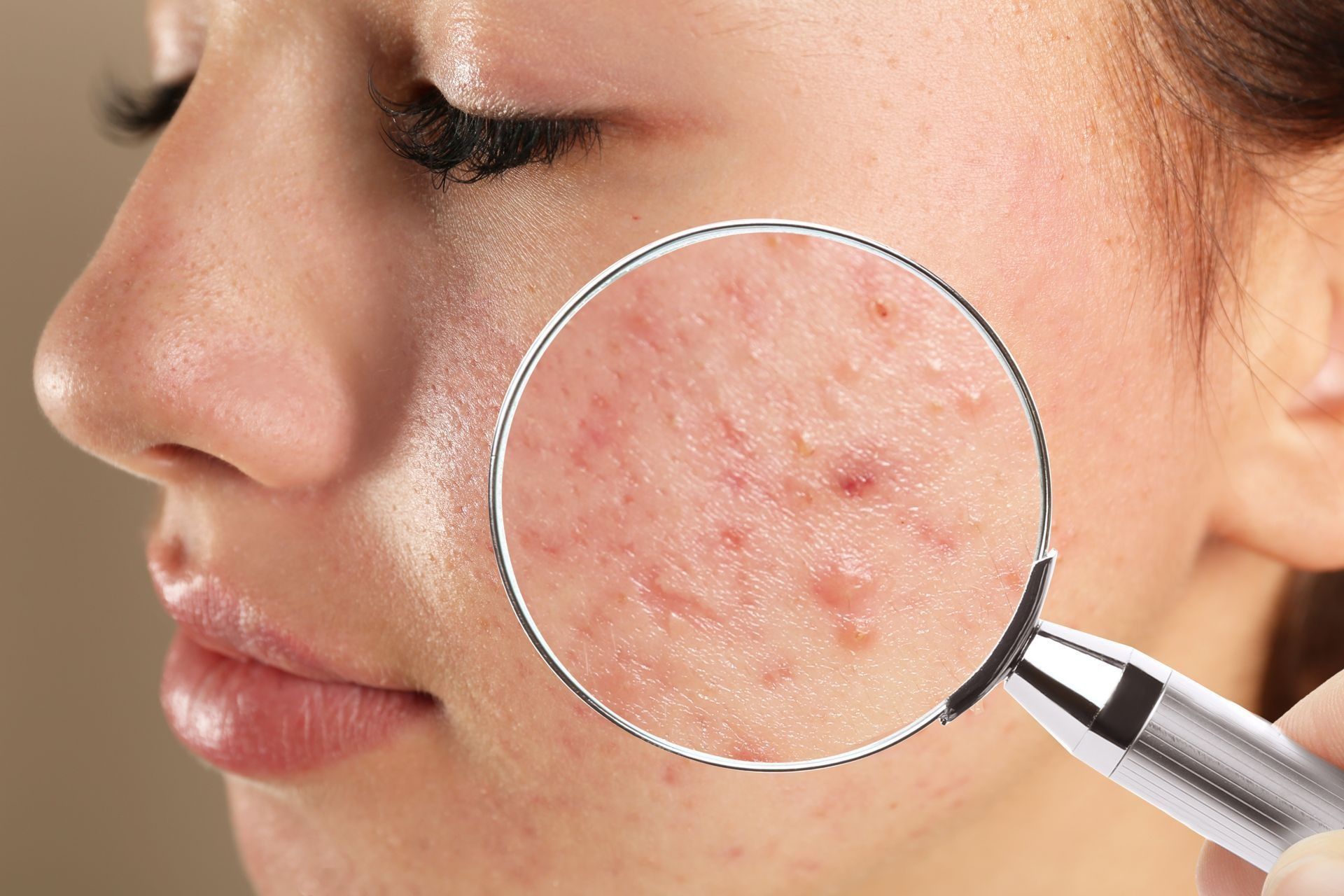 Woman's face with acne highlighted under a magnifying glass, showing blemishes and redness.
