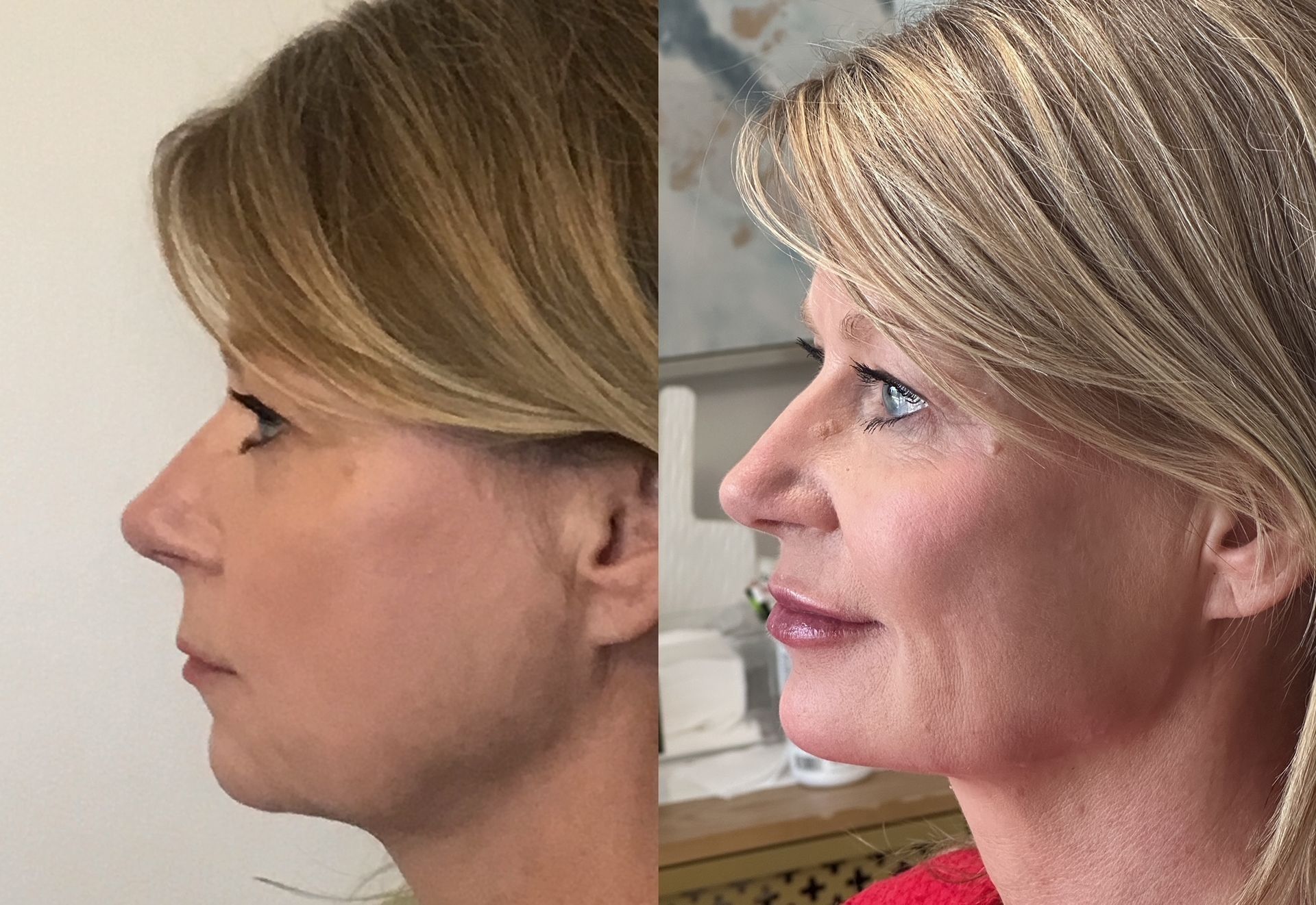 Side-by-side photos of a woman's profile before and after a cosmetic procedure. The 