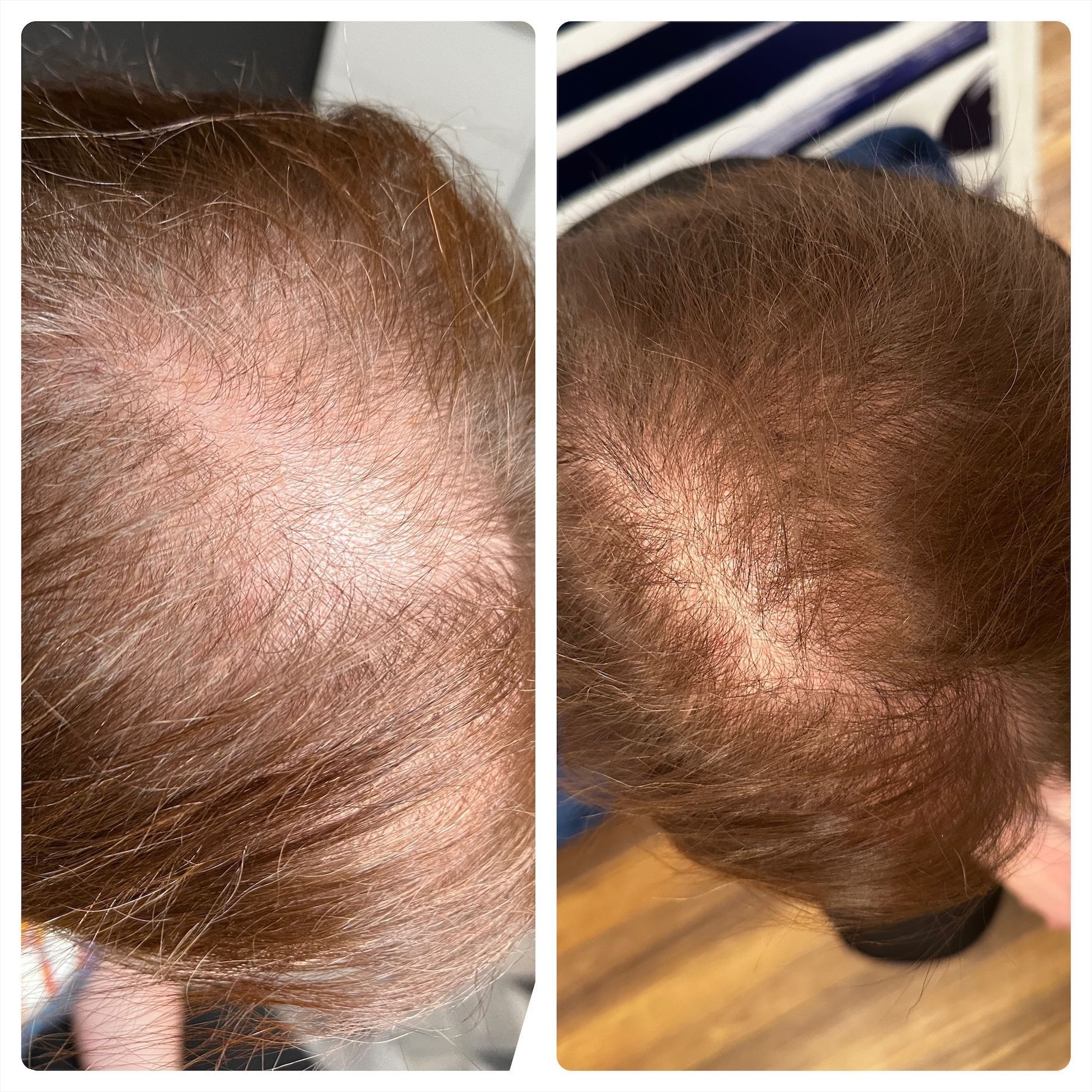 Two views of a person's scalp, showcasing hair growth. The left side shows thinning hair; the right side has denser hair.