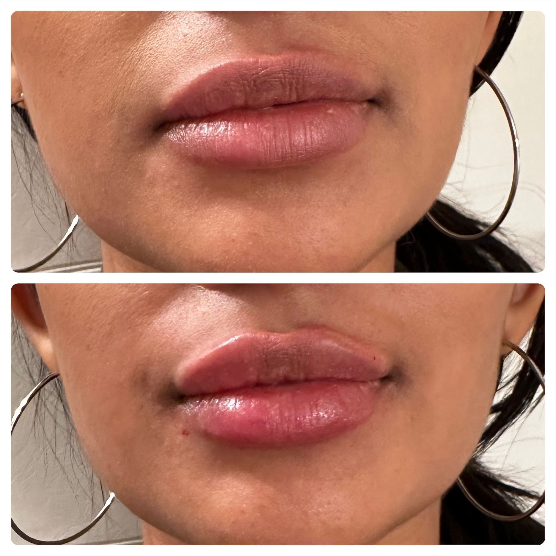 Before and after photos of a person's lips. The bottom photo shows larger, plumper lips than the top.