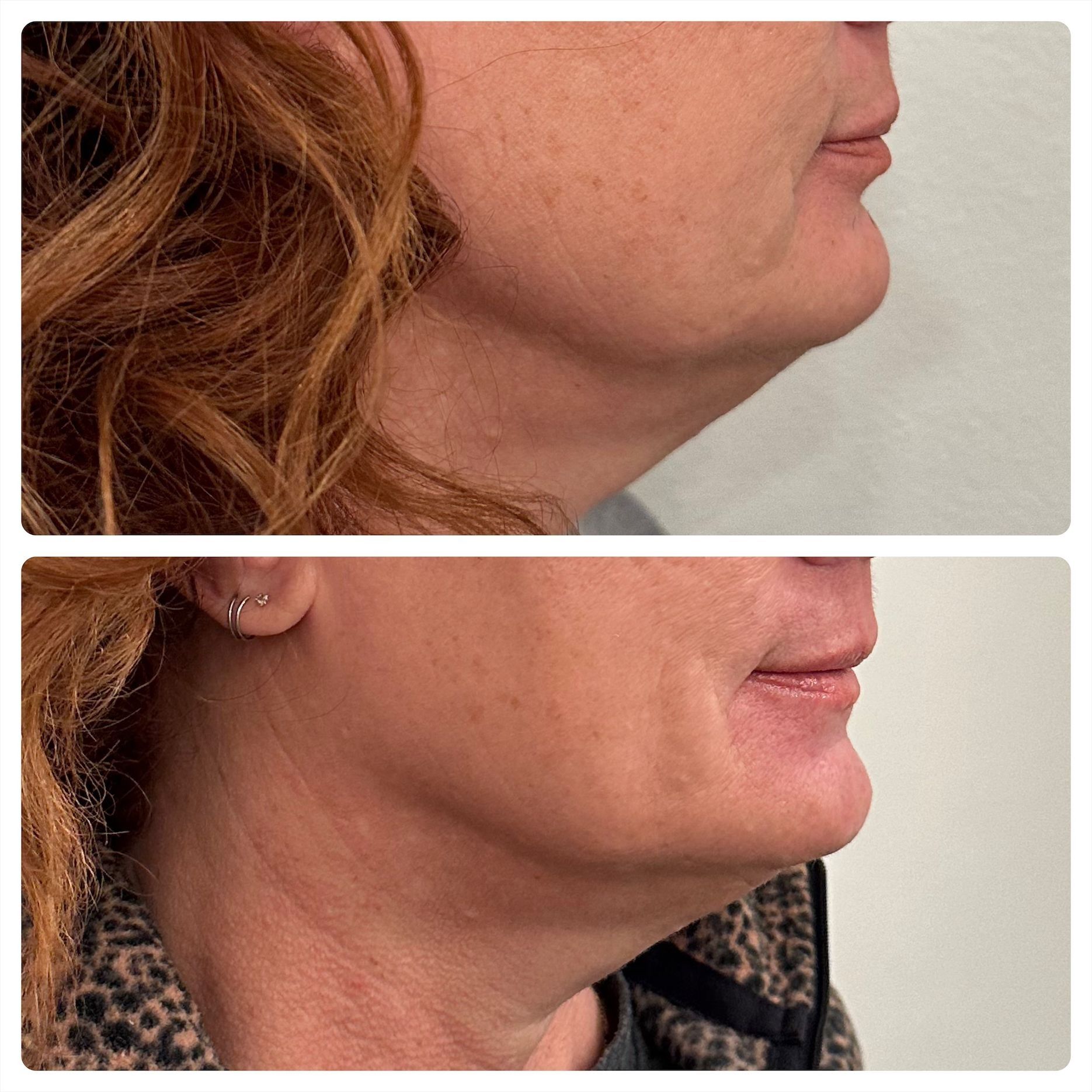 Side-by-side before and after photos of a woman's neck and jawline, showing a reduction in fullness below the chin.