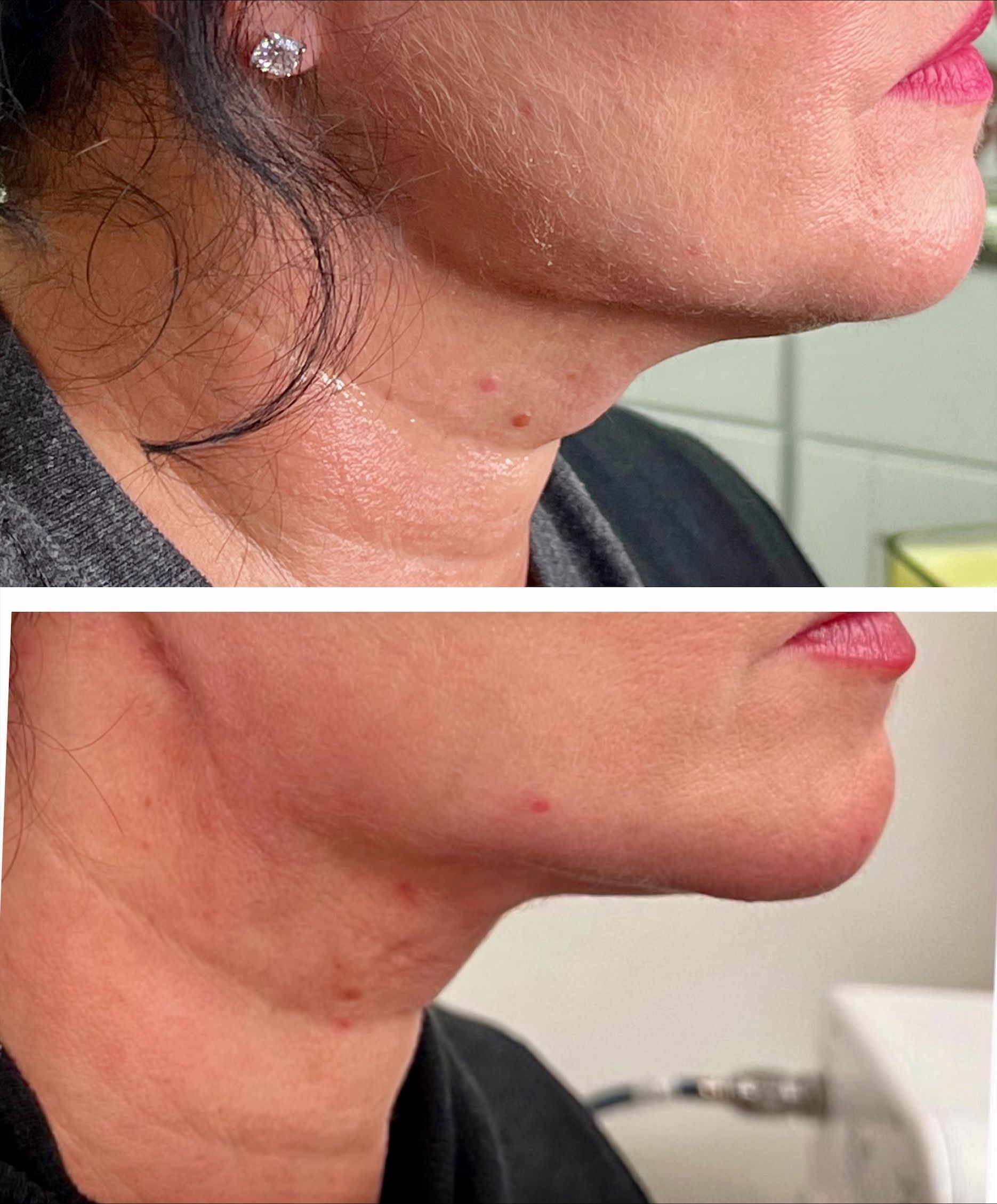 Before-and-after comparison of a person's neck and jawline, showing reduced fullness after a cosmetic procedure. The skin appears pink.