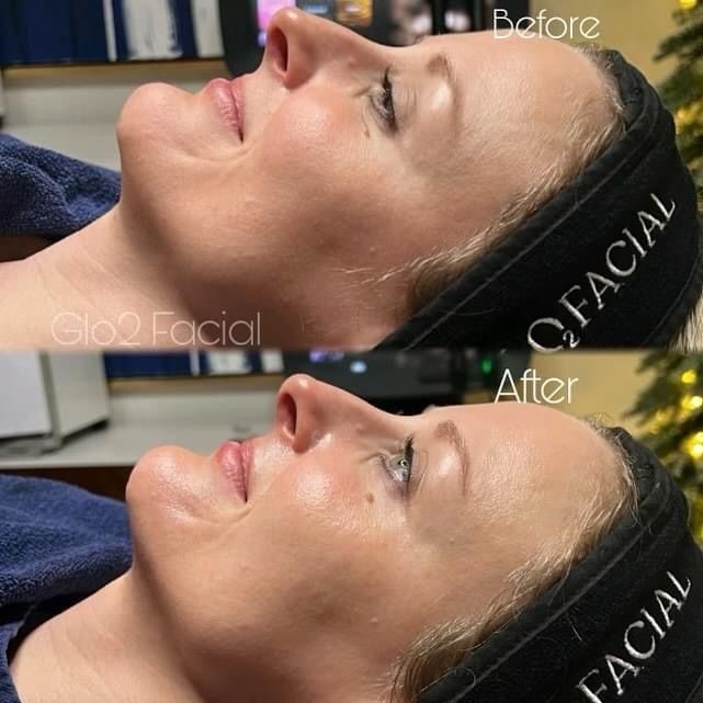 Side-by-side comparison of a woman's face before and after a facial, showing improved skin texture and radiance. She's smiling, wearing a headband.