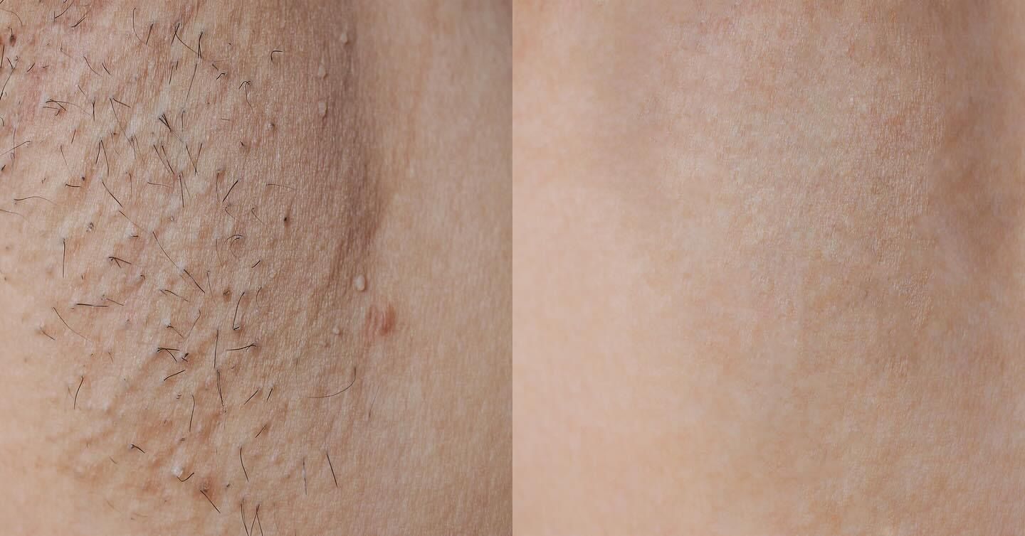 Comparison of skin before and after hair removal; left side shows stubble and small dark spots, right side shows smooth skin.