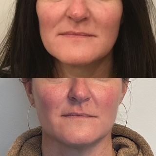 Side-by-side comparison of a woman's face before and after a procedure. The woman's face shows reduced cheek redness and some smoothing.