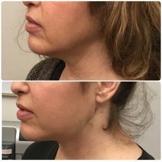 Before and after photos of a woman's profile. The