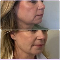 Side-by-side photos of a woman's face before and after a cosmetic procedure, showing reduced lines and wrinkles.
