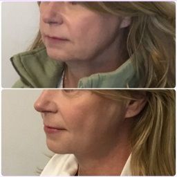 Side-by-side before and after photos of a woman's jawline. The