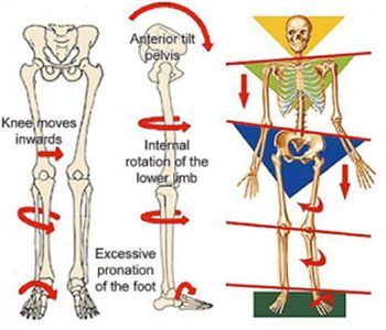 A diagram of a skeleton showing knee moves inwards and excessive pronation of the foot