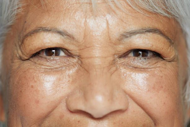 what causes glassy eyes in the elderly