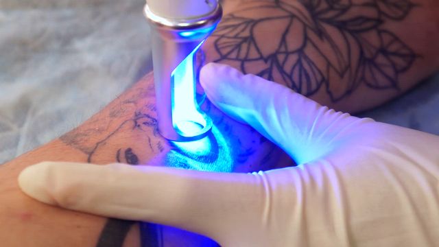 Laser Tattoo Removal for Rochester, Brighton, NY | Dermatology Associates  of Rochester