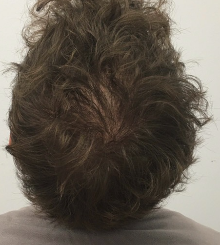 Dark hair after growth