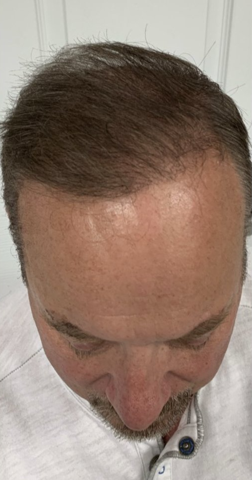 Hair Restoration After - Front View